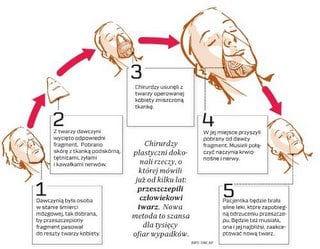Jeszcze o przeszczepie twarzy